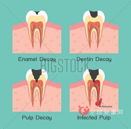 齲齒是什么??？對(duì)于寶寶來說又有哪些危害呢？
