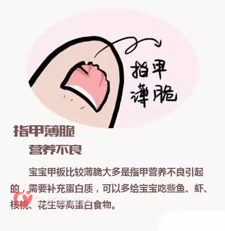 寶寶指甲透露出來的健康問題 爸爸媽媽注意到了嗎？