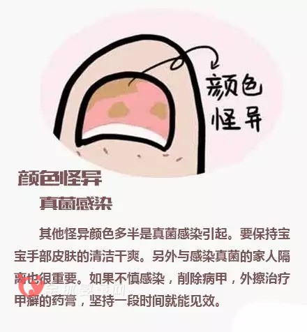 寶寶指甲透露出來的健康問題 爸爸媽媽注意到了嗎？