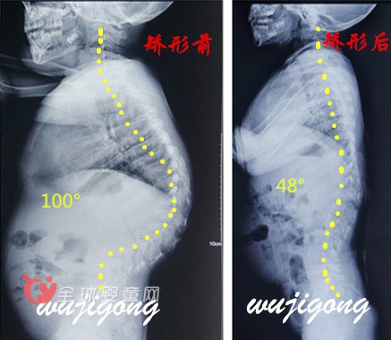 孩子的脊柱側(cè)彎是爸爸媽媽應(yīng)該注意的焦點