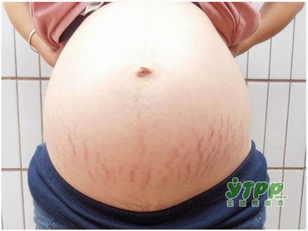 孕期和产后要如何消除孕纹 才能让妈咪们依旧美丽动人