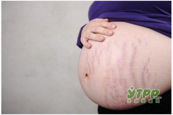 孕期和产后要如何消除孕纹 才能让妈咪们依旧美丽动人