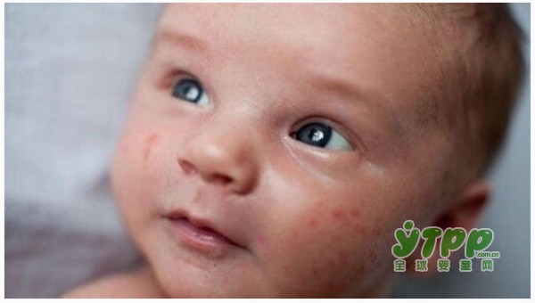 宝宝患有湿疹 忌口和护理同样十分重要！