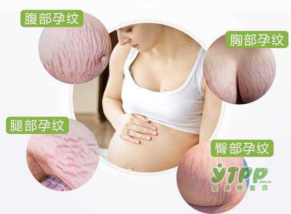 准妈妈孕期避免孕纹 重在预防！