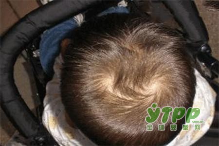 头上有两个发旋的宝宝都特别皮 孩子头上的发旋多是不是意味着好呢